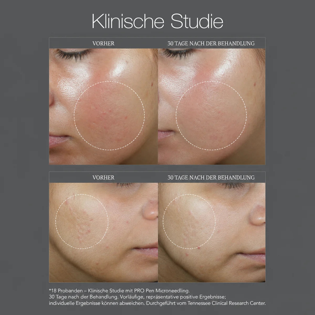 PRO 14-pin microneedling cartridges