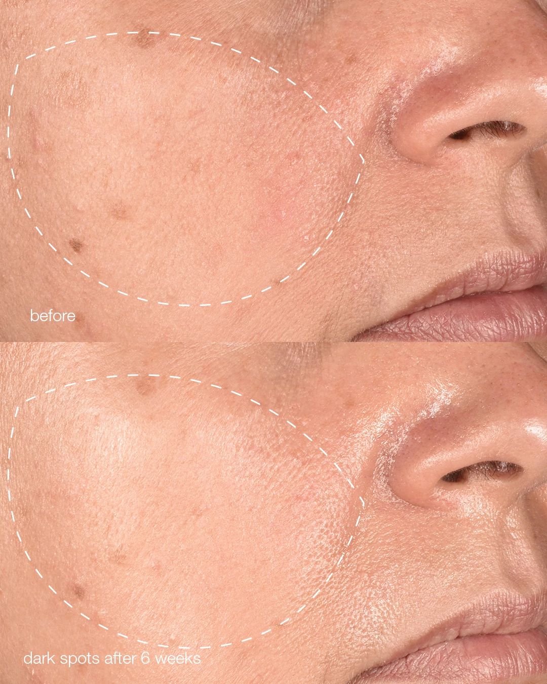 PRO melanopro peel system