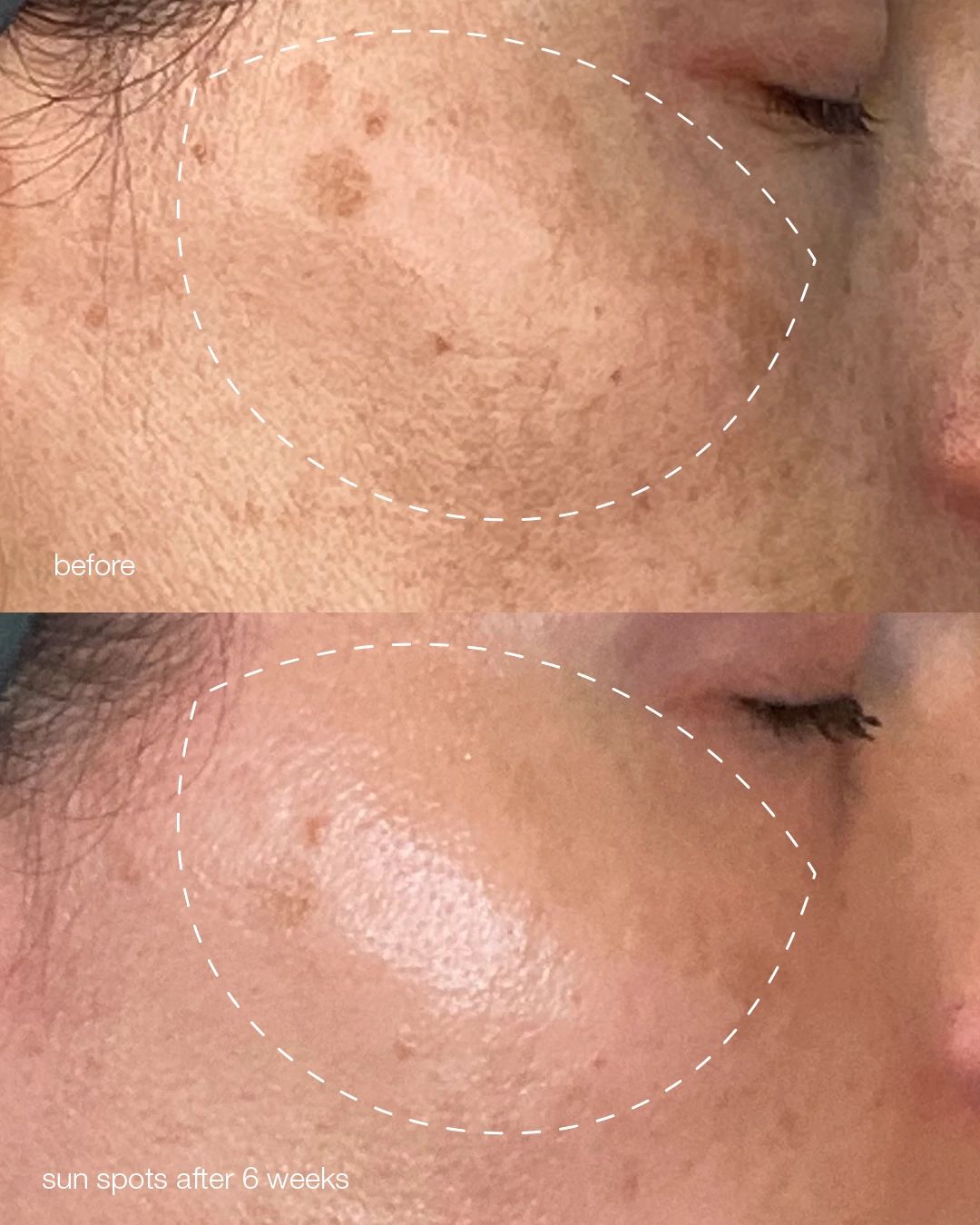 PRO melanopro peel system