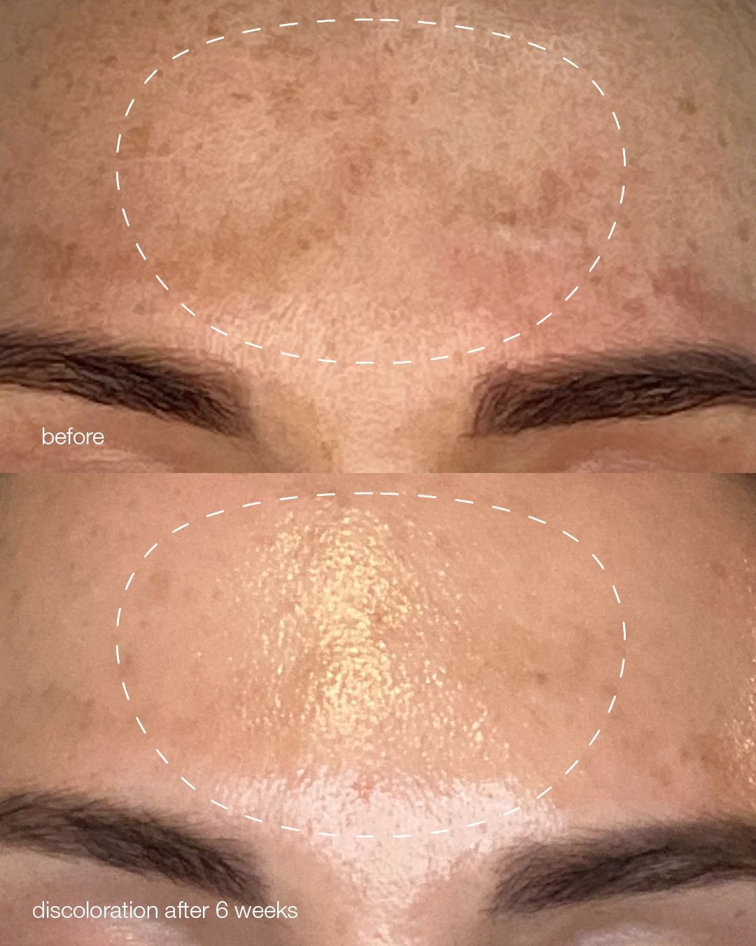 PRO melanopro peel system